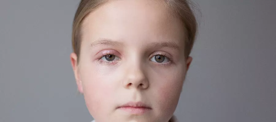Ячмень на глазу у ребенка: лечение, причины возникновения, симптомы, что делать в домашних условиях